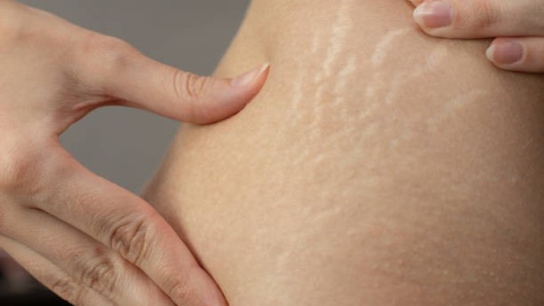 Home Remedies to reduce Stretch Marks